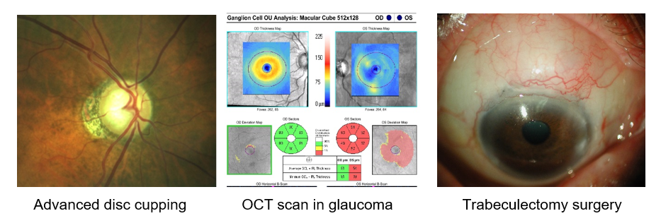 How glaucoma is diagnosed with an OCT scan, how the optic nerve appears in glaucoma and what the eye looks like after glaucoma surgery 