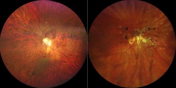 Scarred, stretched tissues of the retina can occur when you are short-sighted or myopic