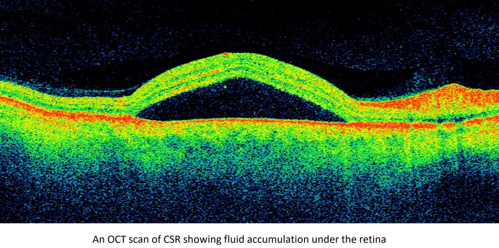The black dome-shaped area is where the fluid accumulates in central serous retinopathy 