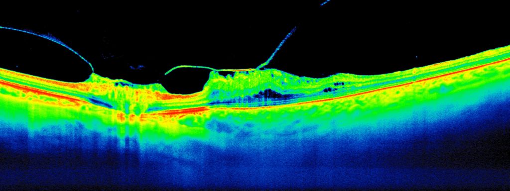 Colour-coded layers of the retina being distorted by tractional forces in vitreomacular traction 