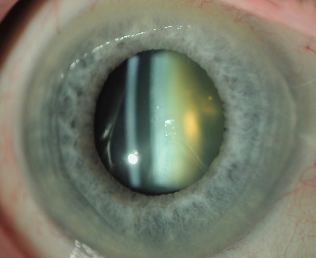 Yellowing of the normally transparent crystalline lens as cataract develops 