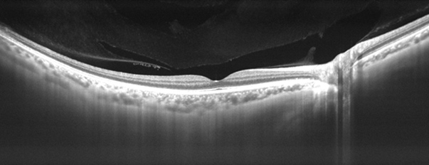 A black and white or grey-scale optical coherence tomography (OCT) scan showing deep tissues of the eye and different layers of the retina 