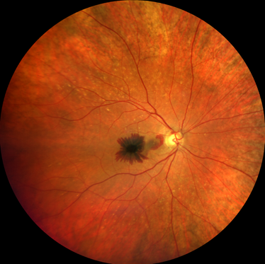 Bleeding at the macula can occur from the new blood vessel growth in macular degeneration 