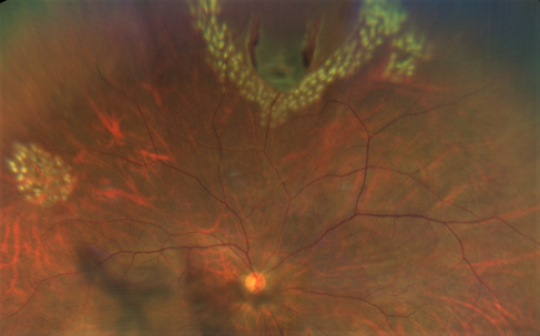 A tear or a break in the retina can be seen at the top, with laser being applied to seal off the area 