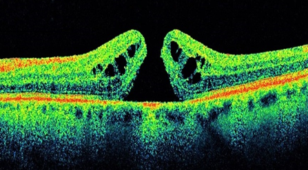 The black gap in the colour-coded layers of the retina in an optical coherence tomography scan is the macular hole 