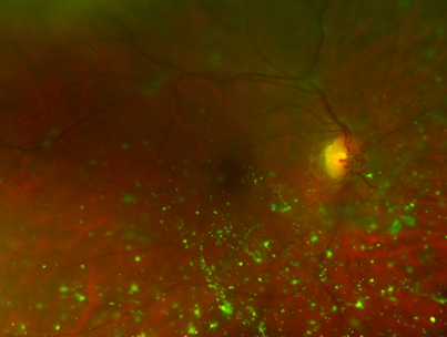 Floaters in the eye can look like a shower of golden flecks or blobs floating around in the vitreous jelly of the eye 