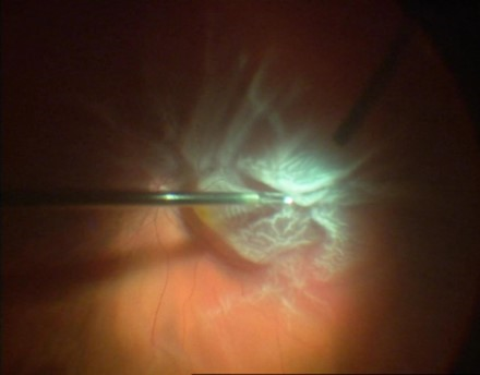 Surgical instrument being used to repair the retina in vitrectomy surgery 