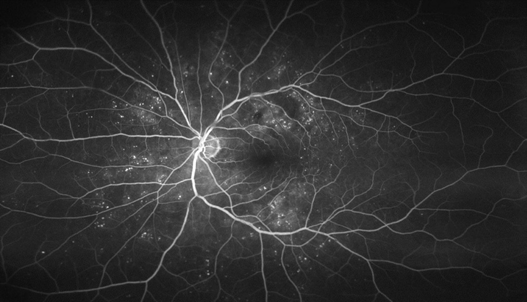A black and white image taken by a photographic test called fluorescein angiography. Blood vessels appear white in the photo