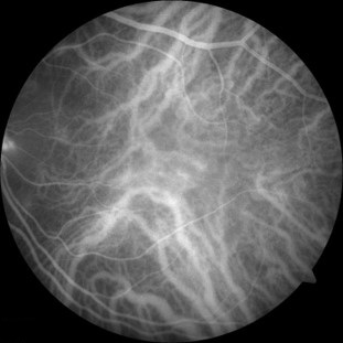 A black and white image taken by a photographic test called indocyanine green angiography. Blood vessels in the deeper layers of the eye appear white in the photo. 