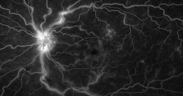 Bleeding and swelling of the retina in retinal vein occlusion 