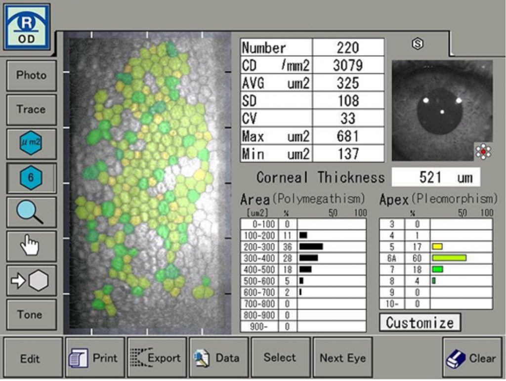 Specular microscopy showing thickness of the cornea and whether cells of the cornea are healthy or not 