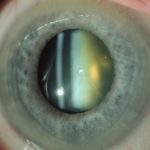 Yellowing of the normally transparent crystalline lens as cataract develops