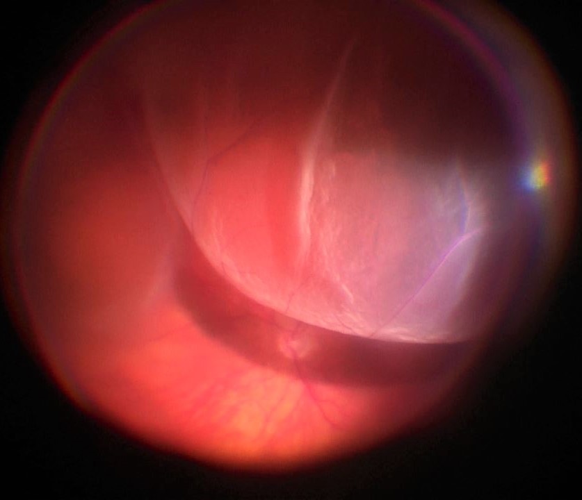 The retina can be seen to be detached from the underlying layers in bullous retinal detachment.