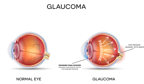 Normal eye versus a glaucoma eye. Eyes with glaucoma have compromised or blocked drainage channels, resulting in a pressure build-up of fluid