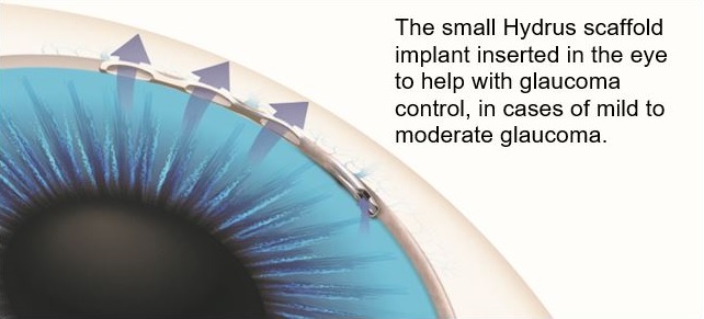 An implantable, flexible, nitinol metal tube with windows placed inside the eye to reduce pressure in glaucoma 