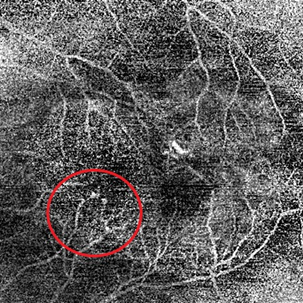 Polypoidal choroidal vasculopathy (PCV) similar to macular degeneration