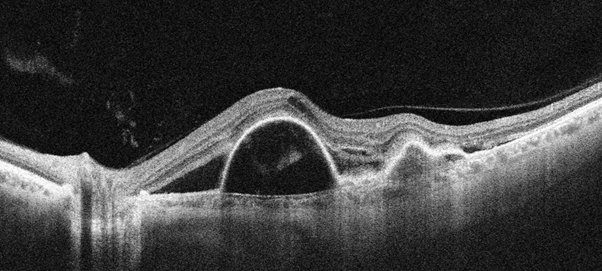 Polypoidal choroidal vasculopathy (PCV) similar to macular degeneration