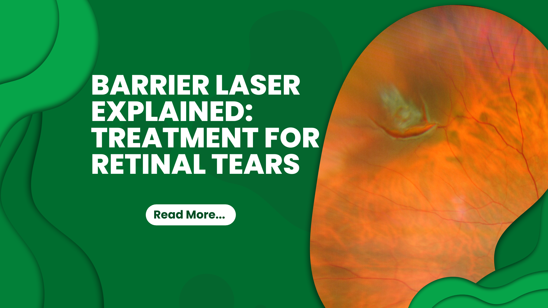 Laser Treatment for Retinal Tears Explained